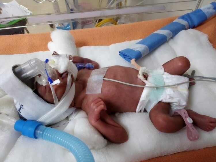 premature baby on ventilator