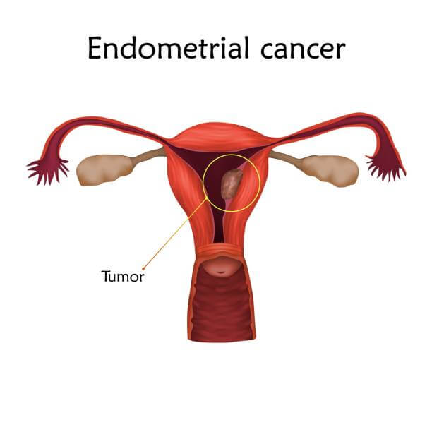 what-is-endometrial-cancer-survival-rate-in-india-impactguru